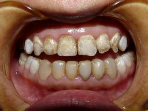 这些药物在牙齿上留下的代谢产物,沉积在牙本质小管内,从而使牙齿呈灰